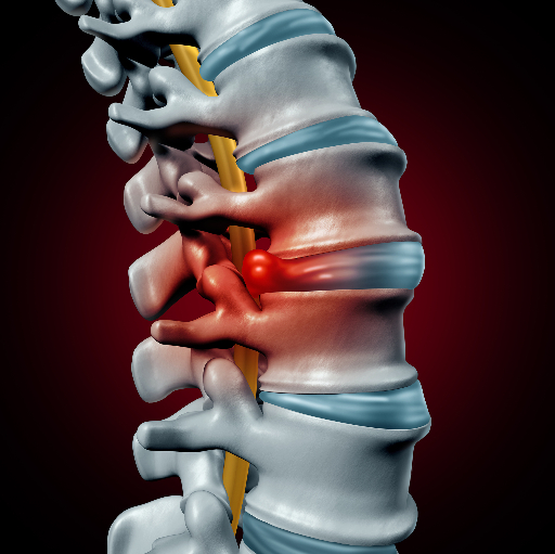 Image d'une hernie discale comprimant les structures nerveuses